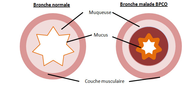 bronches